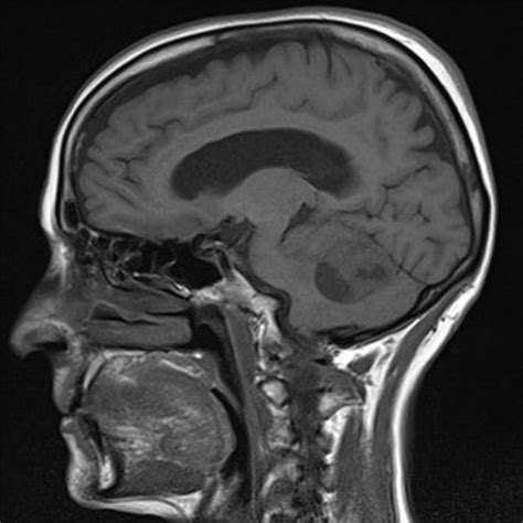 Cerebellar metastases | Radiology Case | Radiopaedia.org
