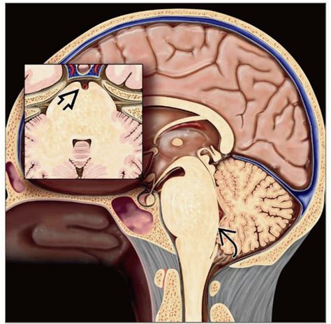 Cerebellum and Brainstem: Diagnosis | Basicmedical Key
