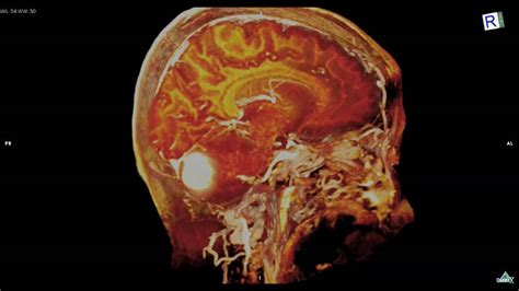 Cerebellum Tumor 3D MRI： 小脳腫瘍   YouTube