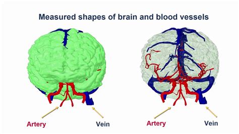 Cerebral Blood Flow Simulation using Altair AcuSolve   YouTube