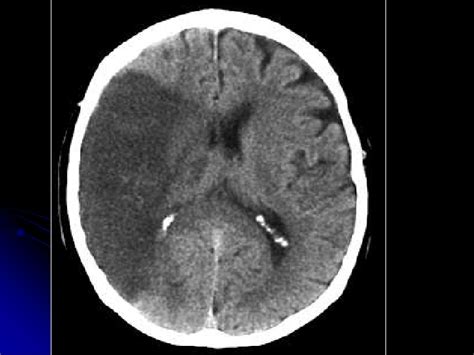 Cerebral Hemorrhage By Arlyn M. Valencia, M.D. Associate ...