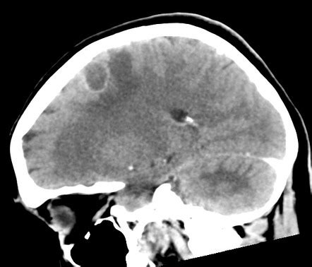 Cerebral metastasis | Image | Radiopaedia.org