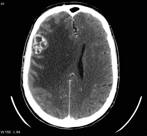 Cerebral metastasis: lung cancer | Image | Radiopaedia.org