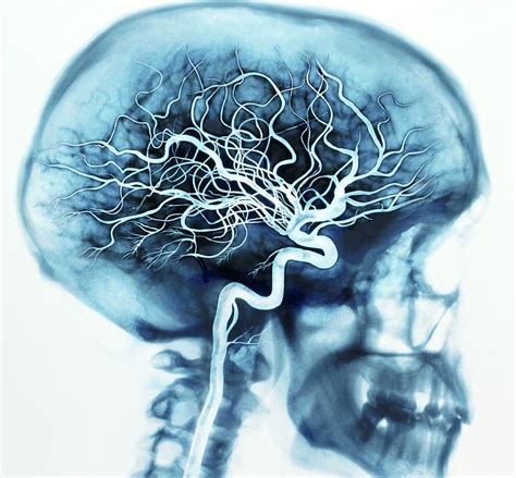 Cerebral vessels   blood flow in the brain : medizzy