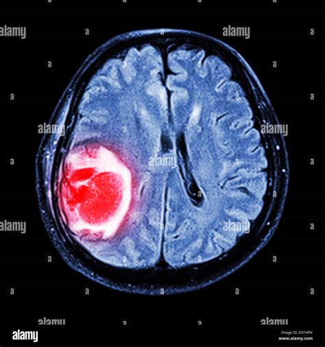 Cerebro : RM muestran tumor cerebral en el lóbulo parietal ...