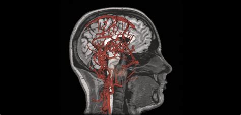 Cerebrovascular disease linked to Alzheimer s disease