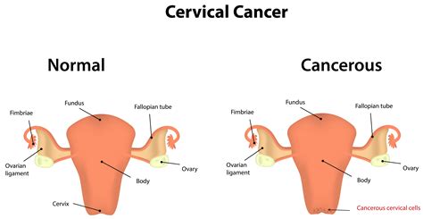 Cervical Cancer   Cancer NewsCancer News
