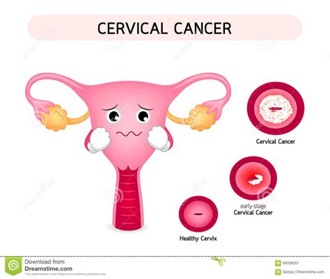 Cervical Cancer Diagram With Sadness Uterus Cartoon ...