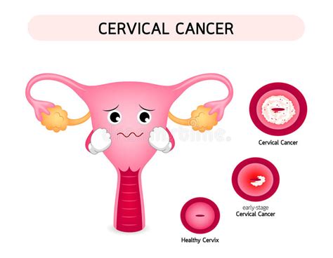 Cervical Cancer Diagram With Sadness Uterus Cartoon ...