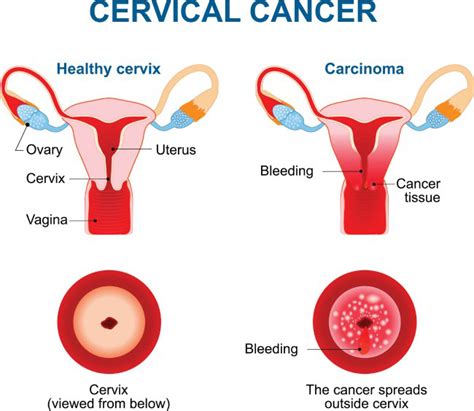 Cervical Cancer Killing Slowly – Kaieteur News