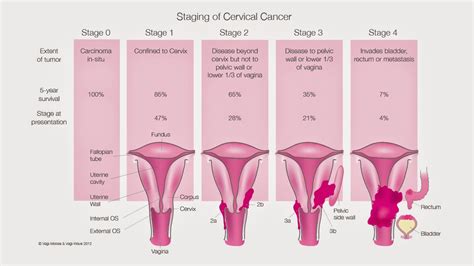 Cervical Cancer: Treatments
