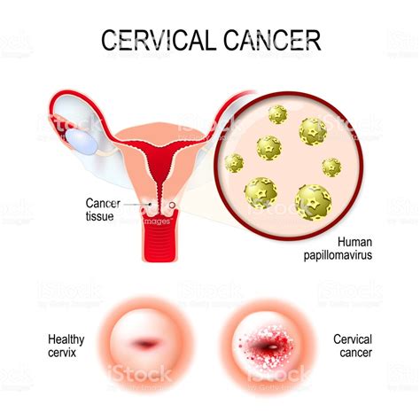 Cervical Cancer Uterus Cervix And Closeup Of The Human ...