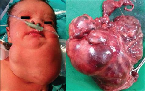 Cervical giant immature teratoma in a newborn: A challenge for survival ...