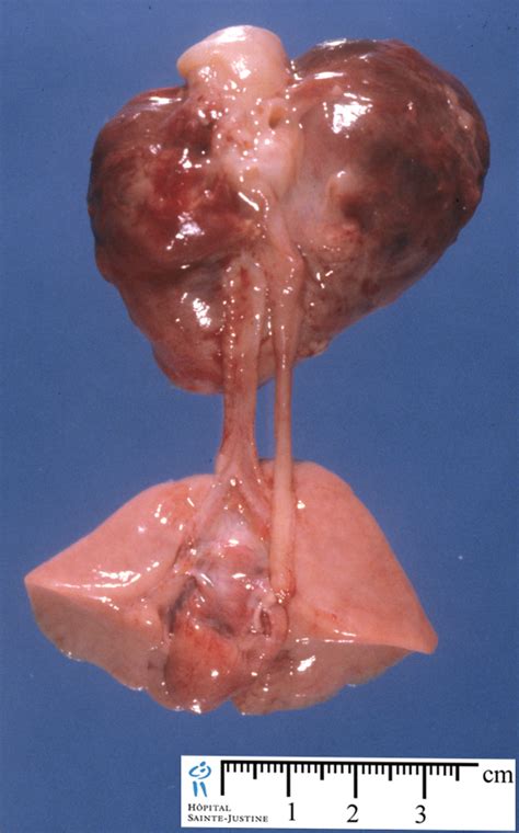 cervical immature teratoma   Humpath.com   Human pathology