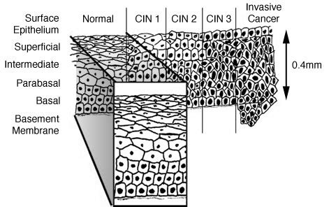 Cervical Intraepithelial Neoplasia  CIN  / Cervical Cancer ...