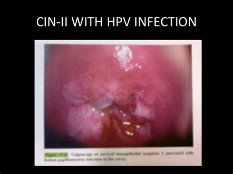 Cervical intraepithelial neoplasia