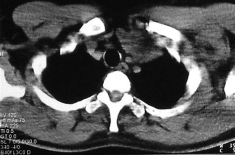 Cervical mature teratoma 17 years after initial treatment of testicular ...