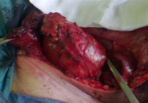Cervical mature teratoma 17 years after initial treatment of testicular ...