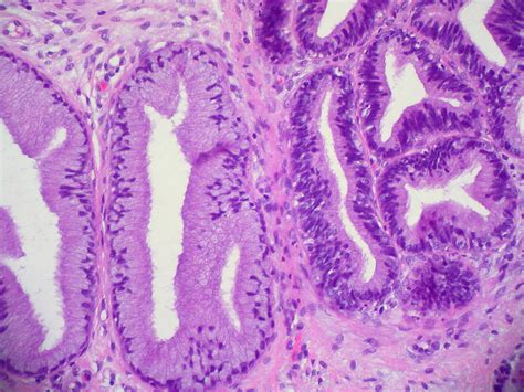 Cervix: Adenocarcinoma in situ | Ed Uthman | Flickr