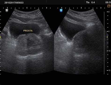 Check Up Prostatico   Ultrasonido 3D y 5D HD Live, doppler y biopsias