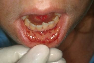 Chemotherapy Induced Oral Mucositis Clinical Presentation ...