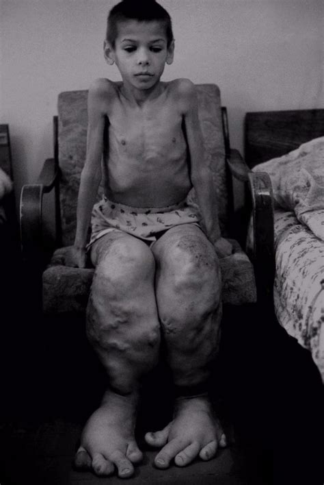 Chernobyl children. The Chernobyl accident led to a sharp increase in ...