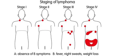Childhood Hodgkin Lymphoma Disease – Stages and Prognosis