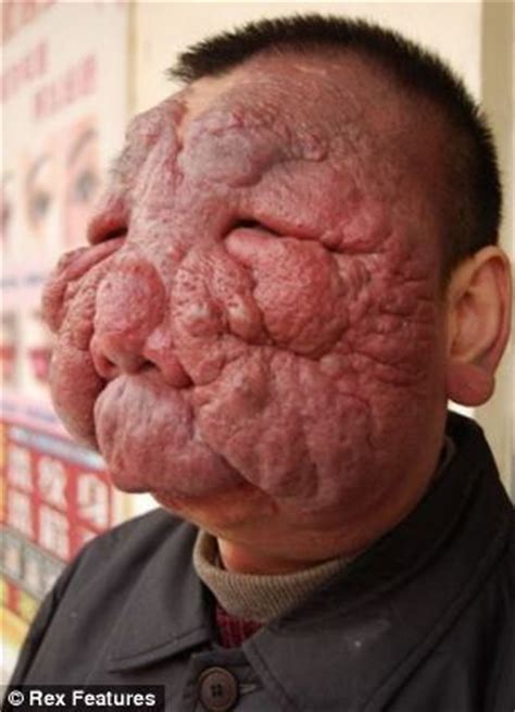 Chinese Man Got Incredible Huge Tumors Removed – Amazing ...