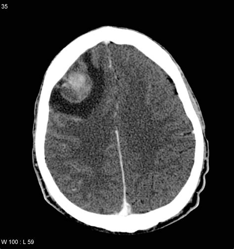 Choriocarcinoma cerebral metastasis | Image | Radiopaedia.org
