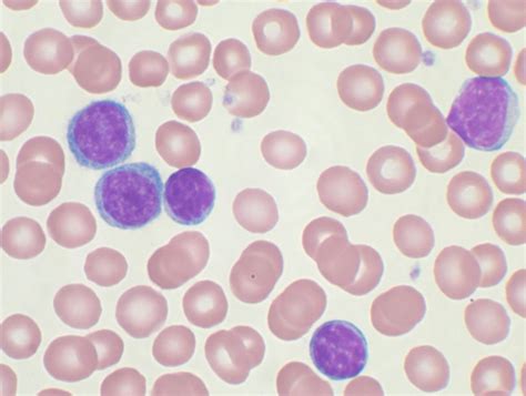 Chronic lymphocytic leukemia   Wikipedia