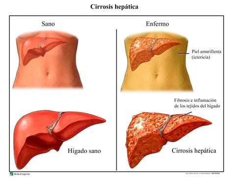 Cirrosis hepática, síntomas, causas, crónica, fase ...