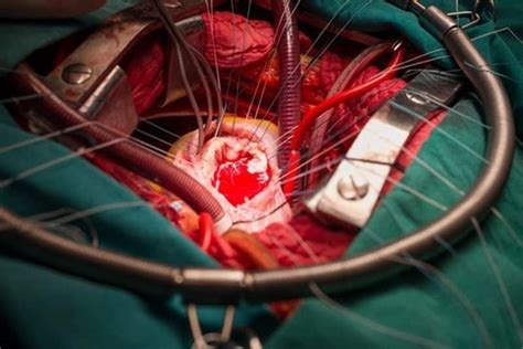 Cirugía a corazón abierto