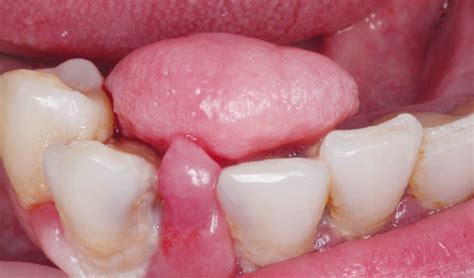 Cirugía bucal de un fibroma traumático – Gaceta Dental