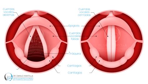 Cirugía de cuerdas vocales | Dr. Danilo Mantilla ORL ...