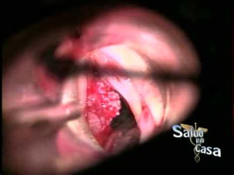 Cirugía de Papilomatosis en Cuerdas Vocales   YouTube