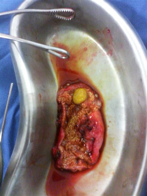 Cirugía de Vesícula Biliar :: Cirugía Laparoscópica