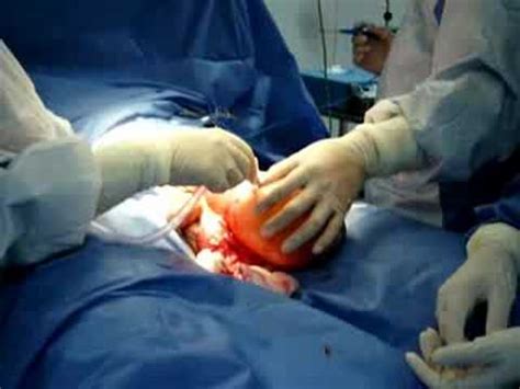 Cirugia tumor testicular   YouTube
