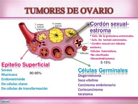 Cirugía: tumores de ovario