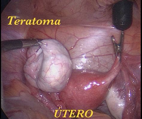 #cirugíasinhuella en paciente con teratoma de ovario izquierdo. imanes ...