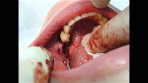 Cirurgia oral cisto dentígero e câncer bucal   Oral ...