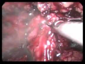 Cistectomia Radical com Neobexiga Ortotópica   YouTube