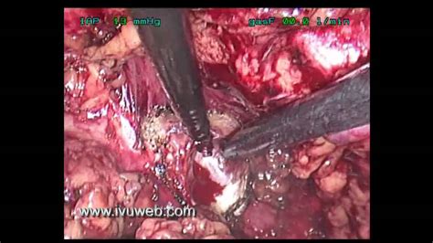 Cistectomia radical laparoscopica IVU   YouTube