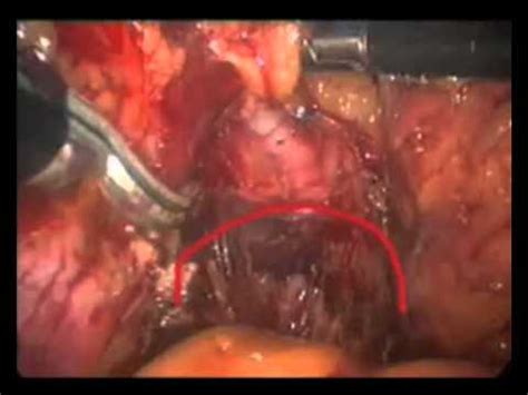 Cistectomía radical laparoscópica.Urologia.mp4   YouTube