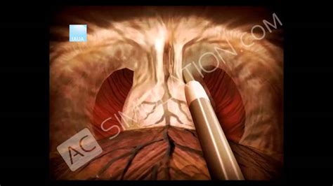Cistectomía radical laparoscópica   YouTube
