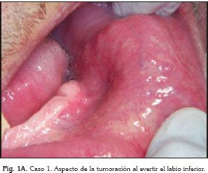 Cistoadenoma de glándulas salivales menores: Presentación ...