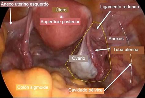 Cistos ovarianos: funcionais ou neoplásicos, benignos ou ...