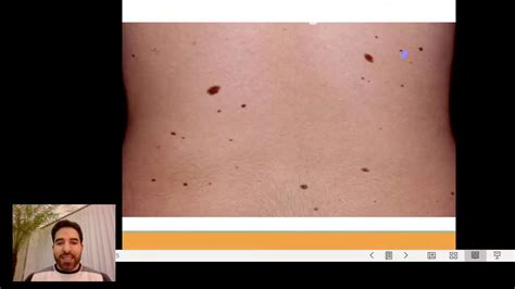 Clase de Dermatologia: Tumores de Piel   YouTube