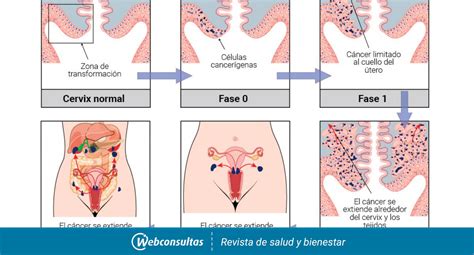 Clasificación y pronóstico del cáncer de cuello de útero