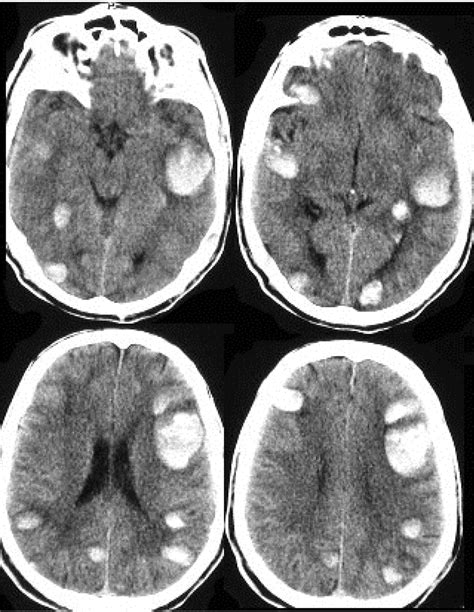 Classification and Pathogenesis of Cerebral Hemorrhages ...