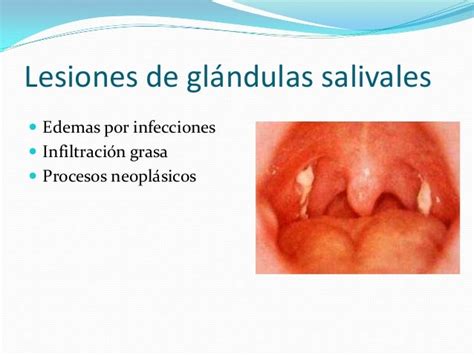 Clínica estomatológica lesiones de las glandulas salivales